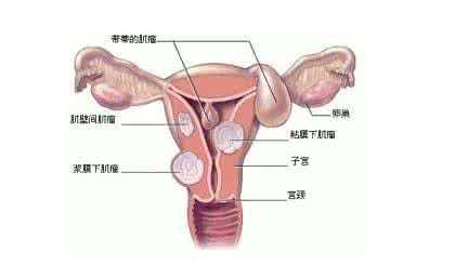 治疗子宫肌瘤的偏方 治疗子宫肌瘤 对症用药治疗子宫肌瘤