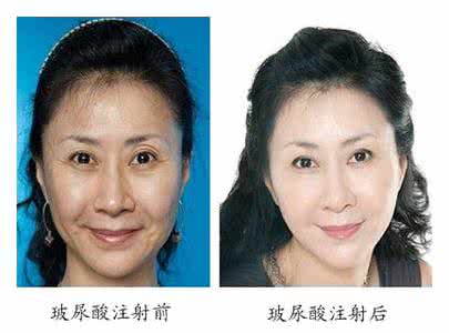 瑞兰玻尿酸注射除皱 瑞兰玻尿酸除皱 瑞兰玻尿酸除皱价格是多少