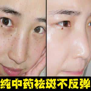 晒斑和雀斑的区别图片 晒斑怎么淡化 5个祛斑小妙招,淡化晒斑雀斑痘印~~