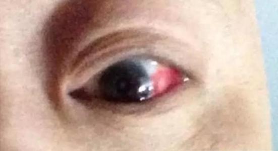 糖尿病眼病治疗方法 糖尿病眼病 如何治疗糖尿病眼病