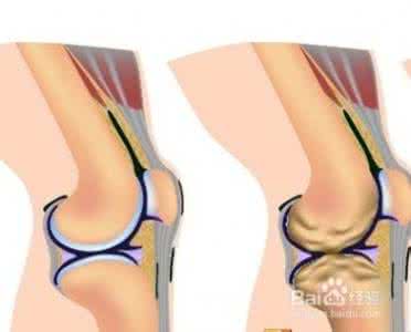 登山膝盖疼 登山膝盖疼 登山膝盖疼是怎么回事呢