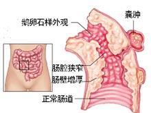 克罗恩病病因 克罗恩病的病因 克罗恩病的症状与治疗