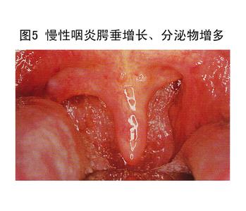 慢性咽炎的典型症状 【慢性咽炎的症状】慢性咽喉炎有哪些典型的症状_慢性咽炎的症状