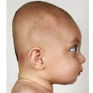 如何纠正宝宝睡偏头 当心宝宝睡偏头！