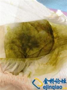 婴儿拉稀屎怎么回事 婴儿拉稀屎怎么回事 婴儿拉稀的原因说明