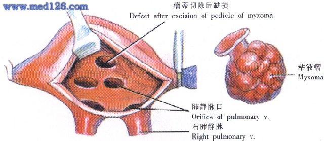 心脏粘液瘤 心脏粘液瘤怎么引起的 心脏粘液瘤的并发症是什么