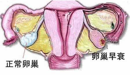 卵巢早衰的症状 如何判断卵巢早衰 10症状找出缘由