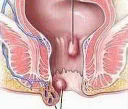 肛门瘙痒肛门湿疹 肛门湿疹 肛门瘙痒 民间方