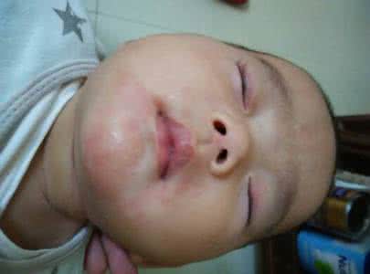 宝宝喝牛奶过敏症状 宝宝喝牛奶过敏的症状有哪些