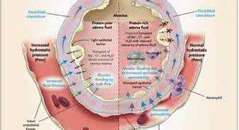 预防肺水肿 肺水肿的病因 肺水肿如何治疗和预防