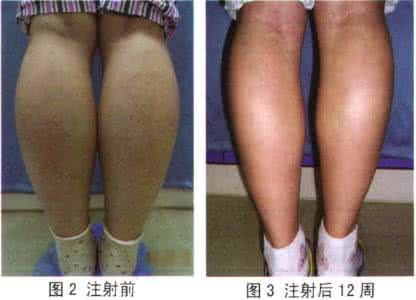 打瘦腿针有什么副作用 瘦腿针有什么副作用呢