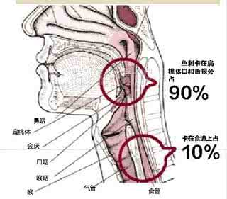 鱼刺卡在喉咙怎么办 鱼刺卡在喉咙怎么办 1种草根，却被称之为“仙”，可消鱼刺，国医大师用来治骨刺