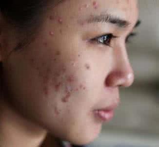 油性皮肤如何去痘印 油性皮肤痘印 油性皮肤如何去痘痘和痘印