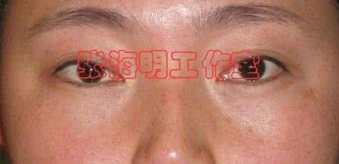 眼袋切除几天恢复好呀 眼袋切除几天恢复好呀 眼袋切除术后的恢复时间