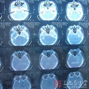 专家解答鼻咽癌 专家称体检EB病毒阳性不等于鼻咽癌