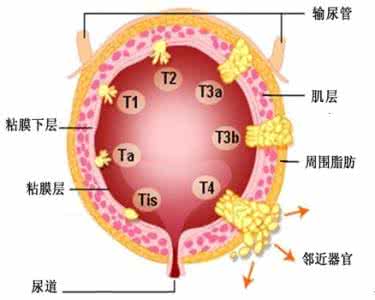 膀胱癌如何治疗 膀胱癌分期 如何治疗膀胱癌