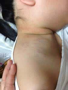 脖子淋巴瘤早期症状 小孩子脖子上有淋巴 小孩脖子上带什么好点？