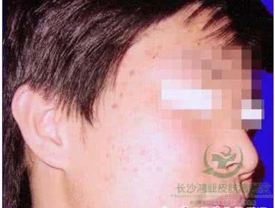 扁平疣患者不能吃什么 如何治疗扁平疣 扁平疣患者不能吃什么