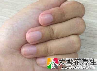 5元钱治疗灰指甲偏方 灰指甲的治疗土方法 小偏方来拯救灰指甲