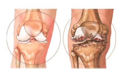 膝盖骨刺的治疗方法 膝盖骨刺的治疗方法 小偏方治疗膝盖骨刺