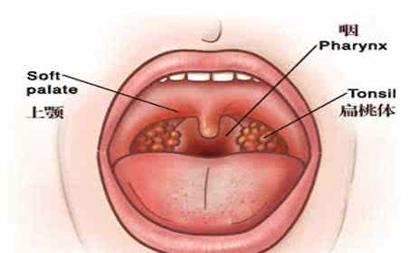 小儿急性喉炎症状 小儿急性喉炎的症状 小儿喉炎的几种表现