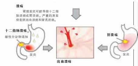 糖尿病治疗手段 抑酸,治疗胃溃疡病的最主要手段