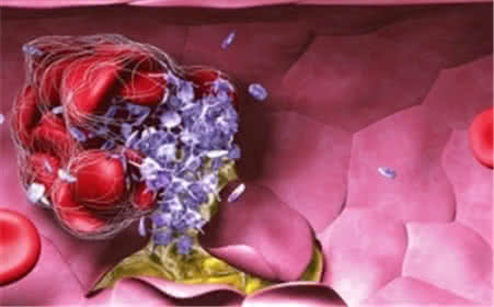 血管内凝血学说股骨头 弥漫性血管内凝血 这些病因导致血管内凝血