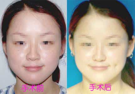 做酒窝整形价格表 酒窝整形价格 做一对酒窝价格需要多少?