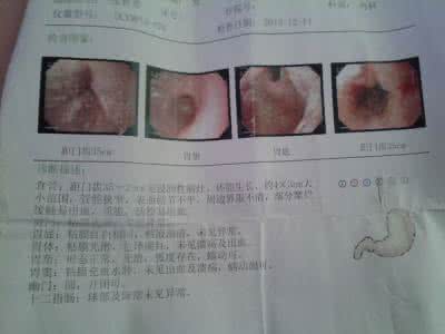 食道癌和胃癌会传染吗 图文：治愈多人的食道癌、胃癌晚期效验秘方