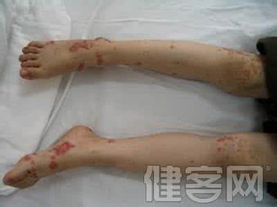 过敏性紫癜西医治疗 过敏性紫癜西医治疗 西医治疗紫癜的方法有哪些