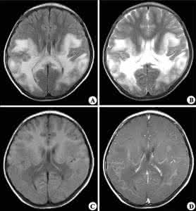 脑白质疏松 脑萎缩 脑白质疏松 对于脑白质疏松的介绍