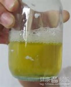 蛋白尿如何治疗 蛋白尿的治疗 如何正确治疗蛋白尿