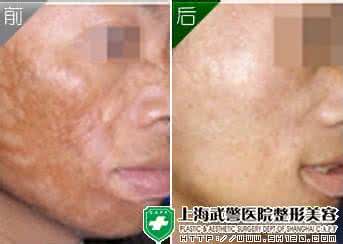 烫伤感染症状 烫伤感染症状 关于烫伤的简述和症状情况