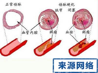 脑动脉硬化会导致 导致动脉硬化的原因 动脉硬化 它是哪些原因导致的