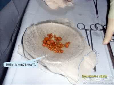胆囊息肉患者饮食 胆囊息肉不能吃什么 胆囊息肉患者不能吃什么?