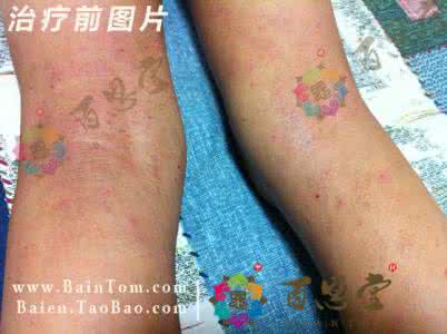 过敏性皮炎治疗方法 过敏性皮炎怎么治 过敏性皮炎治疗方法