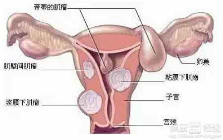 子宫肌瘤吃什么食物 保护子宫吃什么好 对子宫好的三大类食物