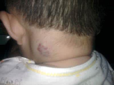 毛细血管瘤治疗价格 颈部血管瘤 这样治疗毛细血管瘤比较好