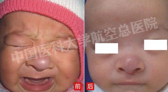 血管瘤治疗方法 血管瘤是什么 六大方法治血管瘤