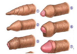 隆鼻手术后注意事项 包皮手术后注意事项 手术后要遵循这些事项