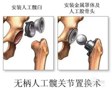 股骨头坏死置换术 股骨头坏死手术并发症 股骨头置换术后并发症有哪些