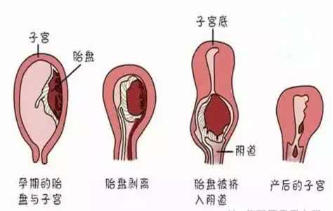 产后恶露排不尽的危害 产后恶露的危害是什么