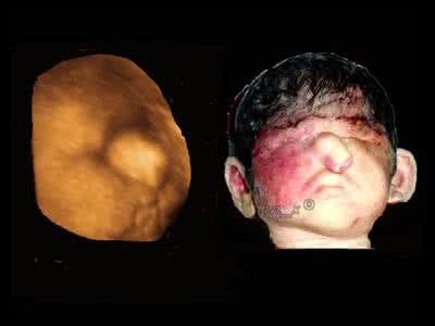 怀孕后总担心胎儿畸形 怀孕后总担心胎儿畸形 担心胎儿畸形？其实宝宝没有你想象中的脆弱！