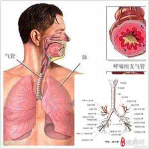 支气管哮喘的早期症状 支气管哮喘治疗方法