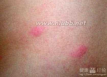 过敏性荨麻疹的治疗 治疗过敏性荨麻疹 过敏性荨麻疹怎么办 荨麻疹的治疗