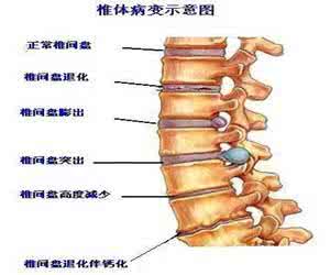 腰间盘突出有效治疗 腰间盘突出能治好吗 有效治疗腰部疾病