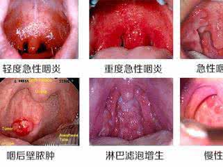 治疗咽喉炎的偏方 咽喉炎的治疗 13偏方帮你治咽喉炎