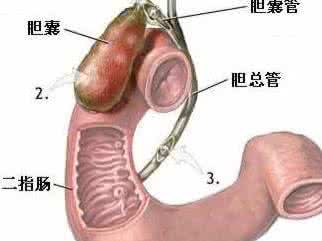 胆囊切除后有什么忌口 胆囊切除后遗症有哪些