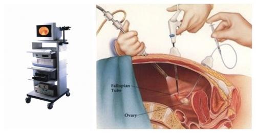 宫外孕治疗要多少钱 宫外孕怎么办 以手术治疗为主
