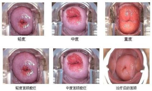 宫颈糜烂主要原因 宫颈糜烂原因